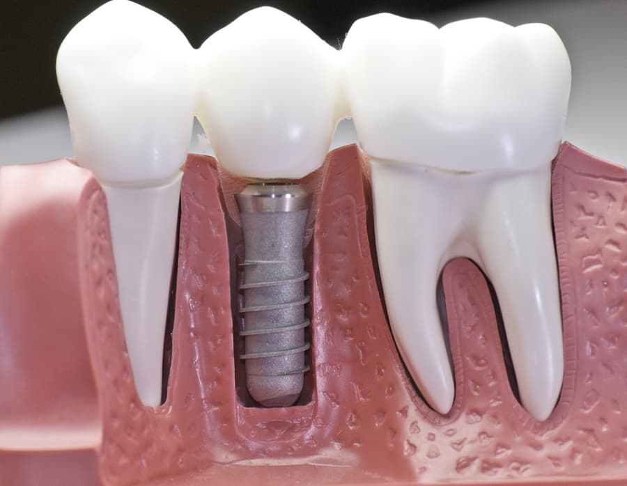 Implants — Case 05