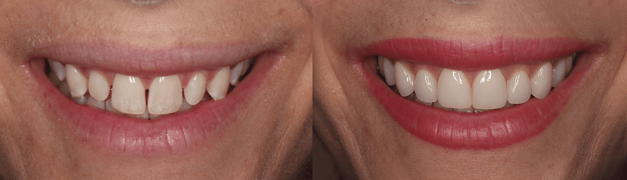 Ten Upper Veneers