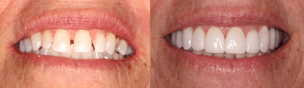 No-Prep Microthin Veneer