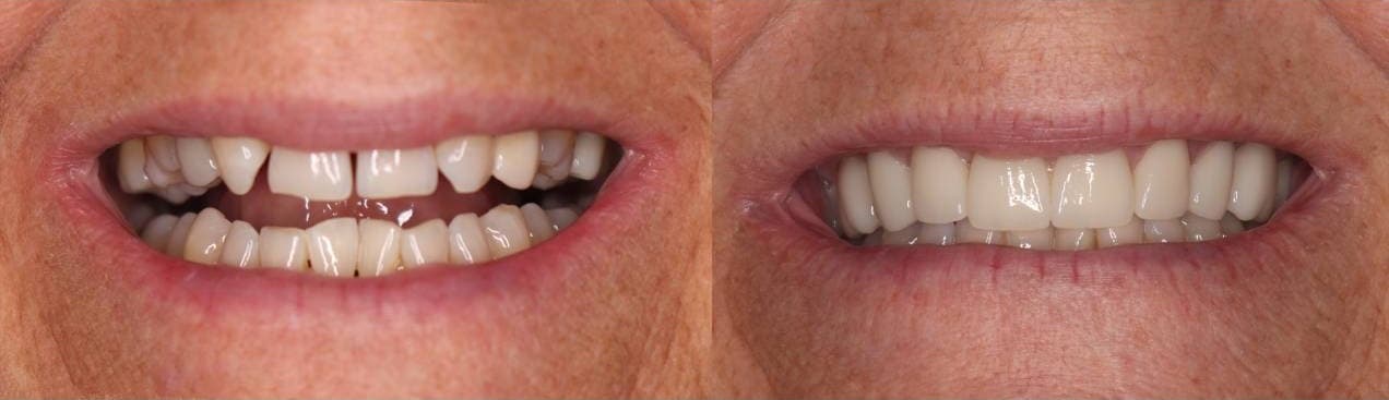 Ceramic Crowns