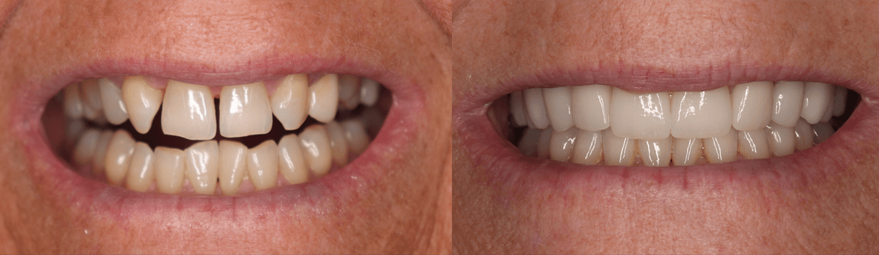 Ten Ceramic Crowns