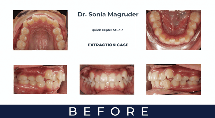 Extraction Case