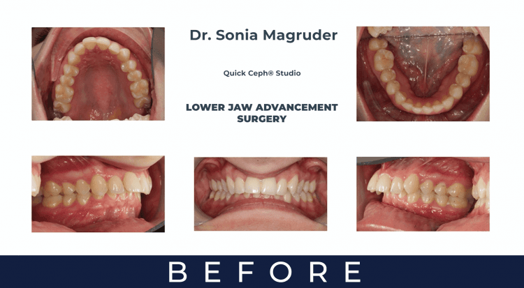 Lower Jaw Advancement