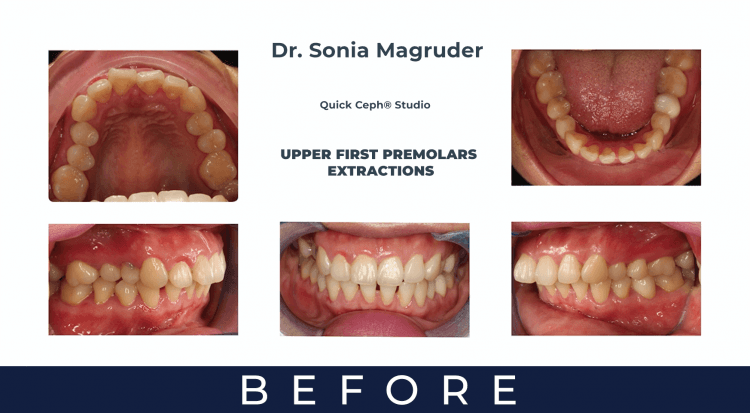 Upper First Premolar Extractions